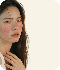 Hassas Cilt & Kızarıklık